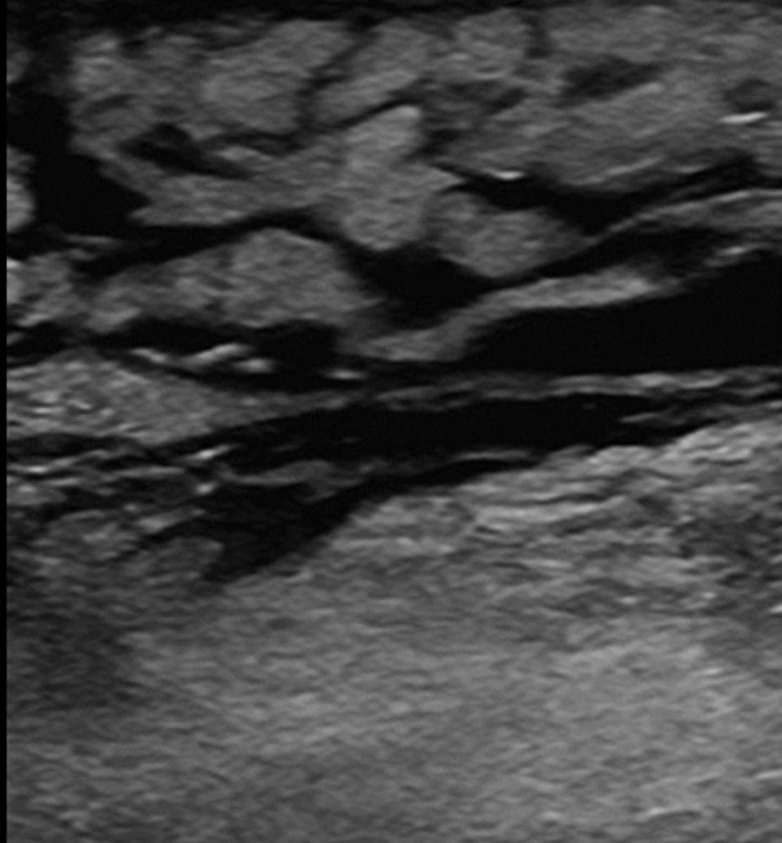<p>Fluid collection in tissues</p><p>Indicative of venous congestion</p>
