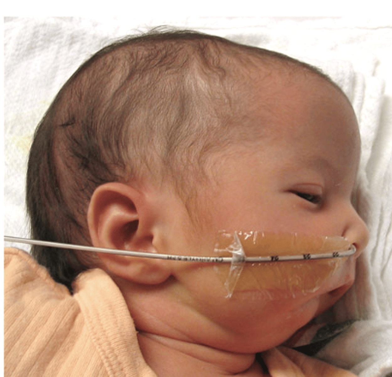 <p>- small recessed jaw</p><p>- Many chromosomal conditions associated with this finding (pierre-Robin syndrome)</p>