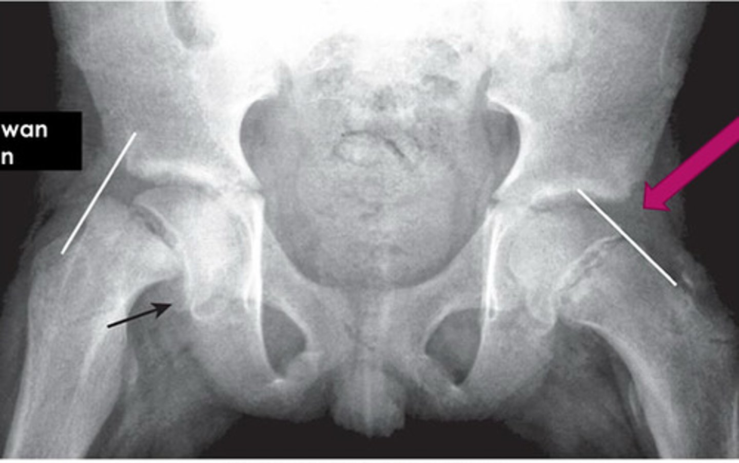 <p>arbitrary line drawn along superior edges of femoral neck; useful in detecting early slipped upper femoral epiphysis in adolescents; line should normally intersect lateral aspect of superior femoral epiphysis on AP view</p>