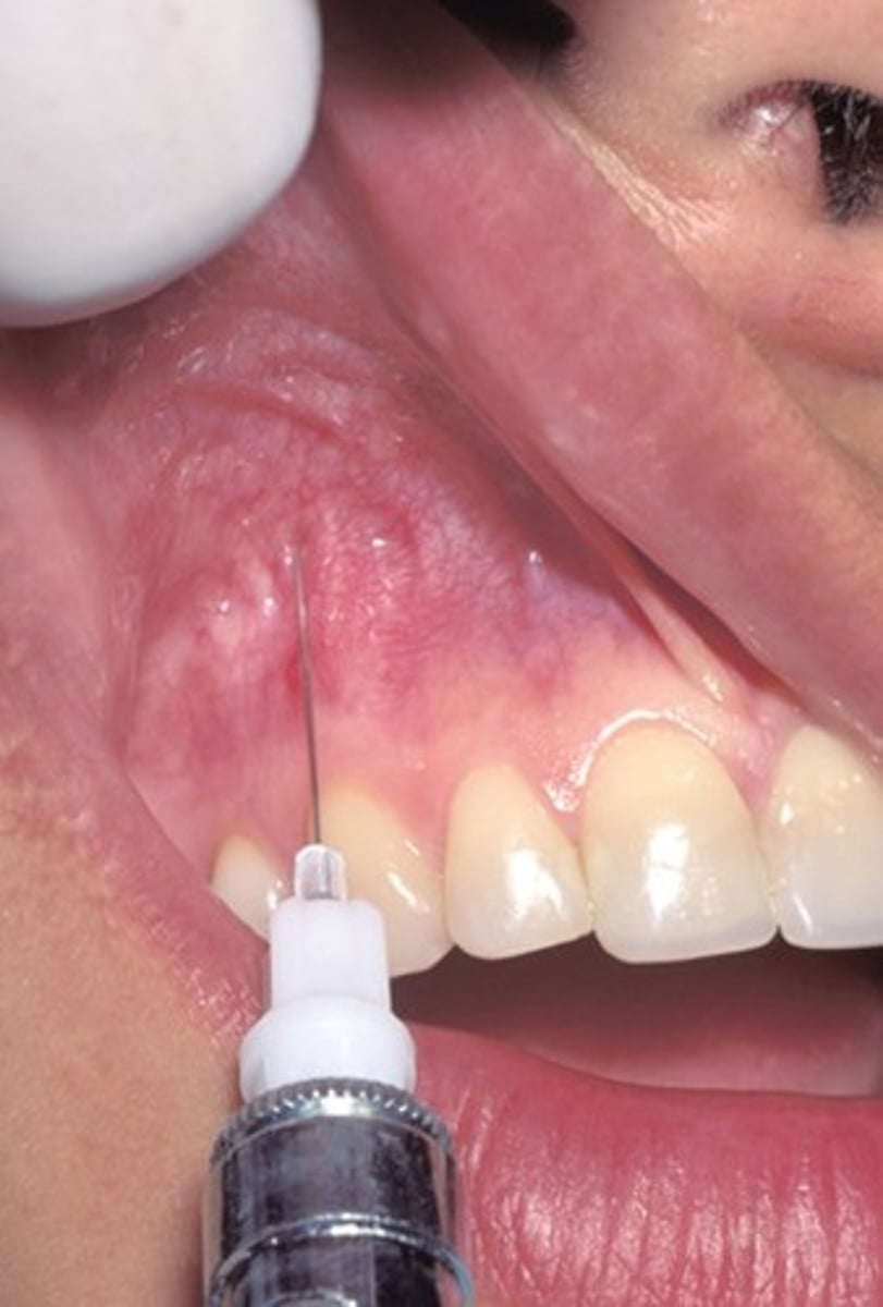 <p>apex of the canine, parallel with the canine emine</p>