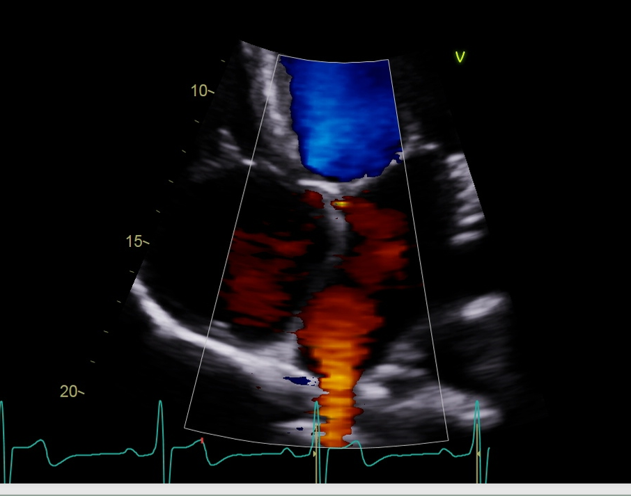 <p>Obtain Pulmonary veins with color (optimization 2-5 sample volume)</p>
