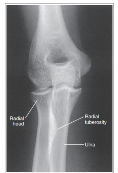 <p>What is wrong with this external oblique elbow? </p>