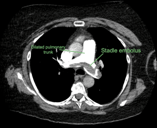 <p>PE</p><p>Obstruction in pulmonary arteries</p><p>Pulmonary infarction</p>