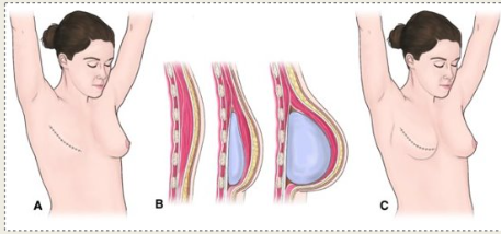 <p>what reconstructive procedure is this?</p>