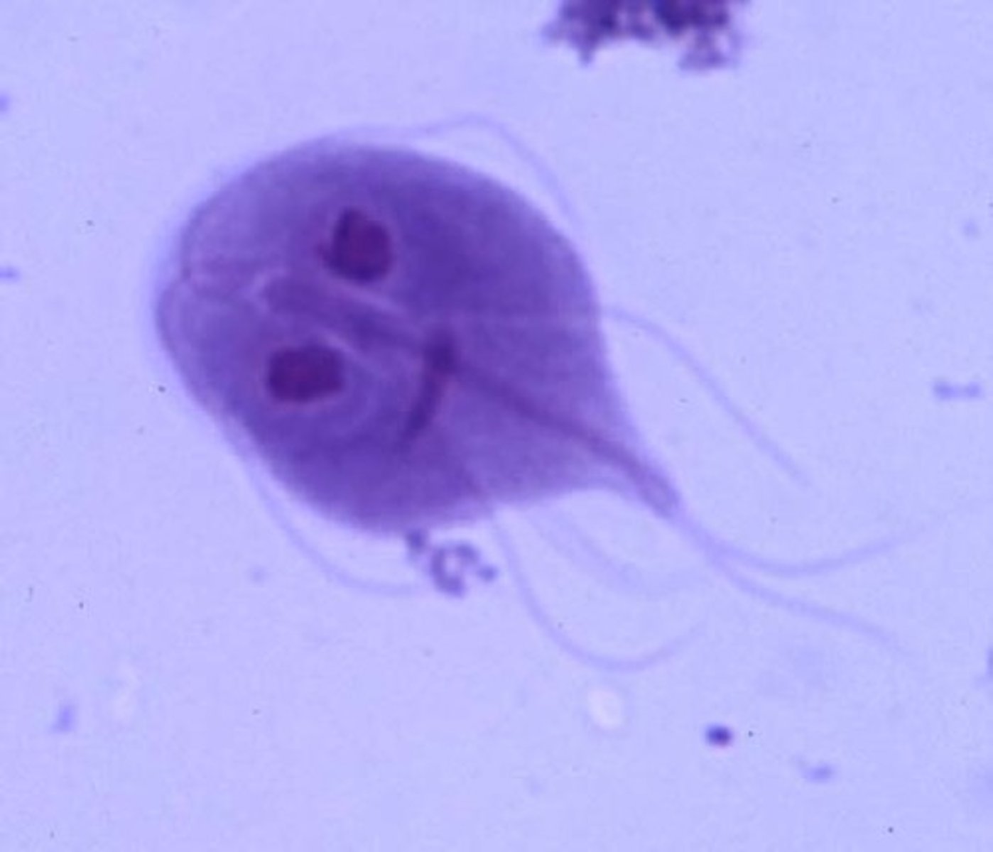 <p>chronic diarrhea caused by a flagellated protozoan</p>