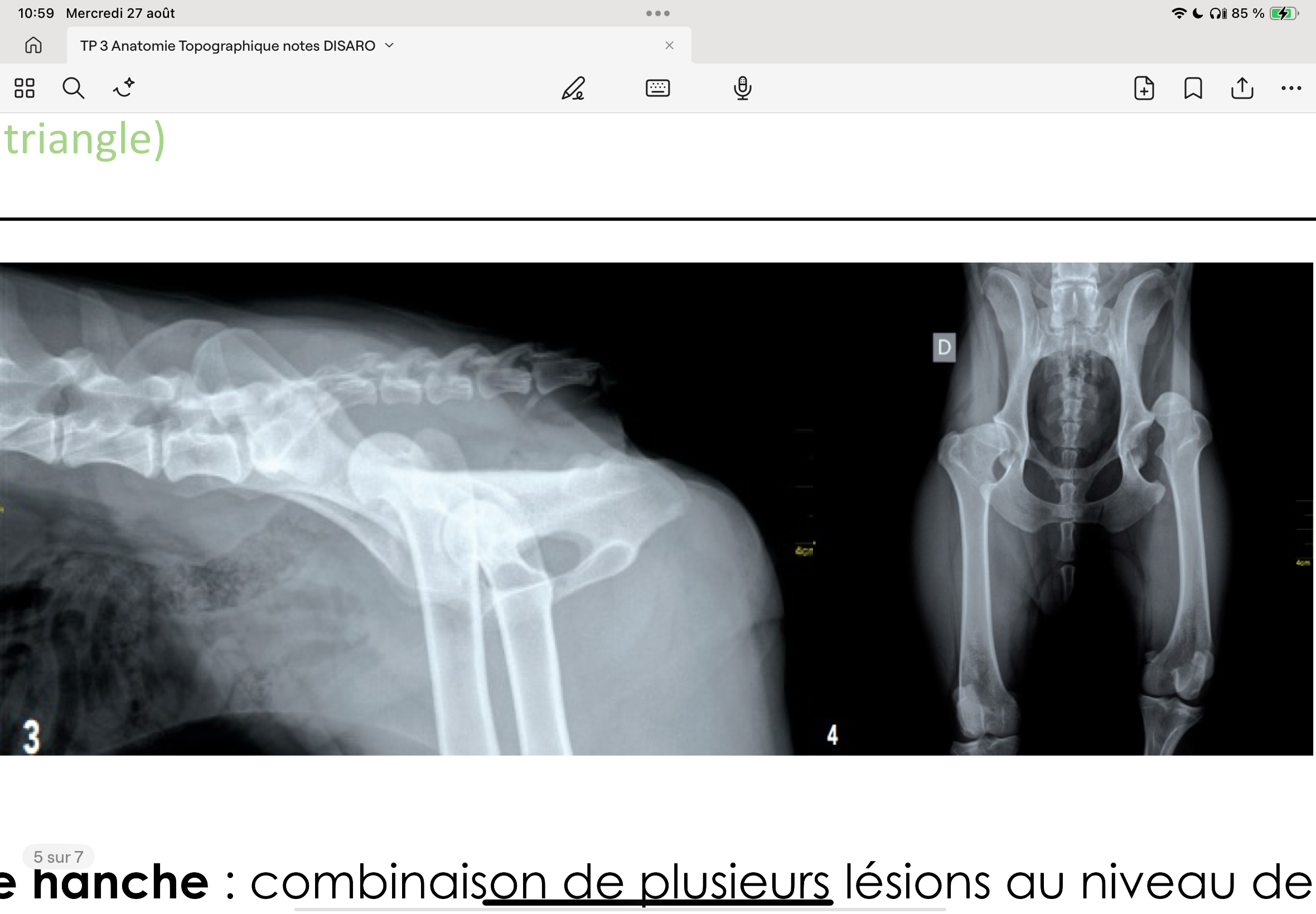 <p>Luxations : le plus souvent en cranio-dorsal mais cranio-caudal et ventral sont aussi possibles.</p><p>Risque de lésion du nerf sciatique</p><p>Possibilités de traitement: Anesthésie profonde et remise en place de l’articulation mais attention car le ligament de la tête de l’humérus ne rompt pas, il s’étire -&gt; mettre un bandage pour maintenir l’humérus dans l’acétabulum</p><p>Diagnostique: Visible sur une radio en vue latérale ou ventro-dorsale ou bien par palpation car les reliefs osseux de l’ilium, du trochanter et de l’ischium se retrouvent alignés lors de luxation.(physiologiquement ils forment un triangle)</p>