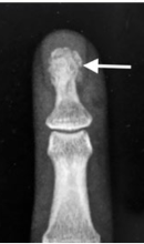 <p>What type of fracture is this?</p>