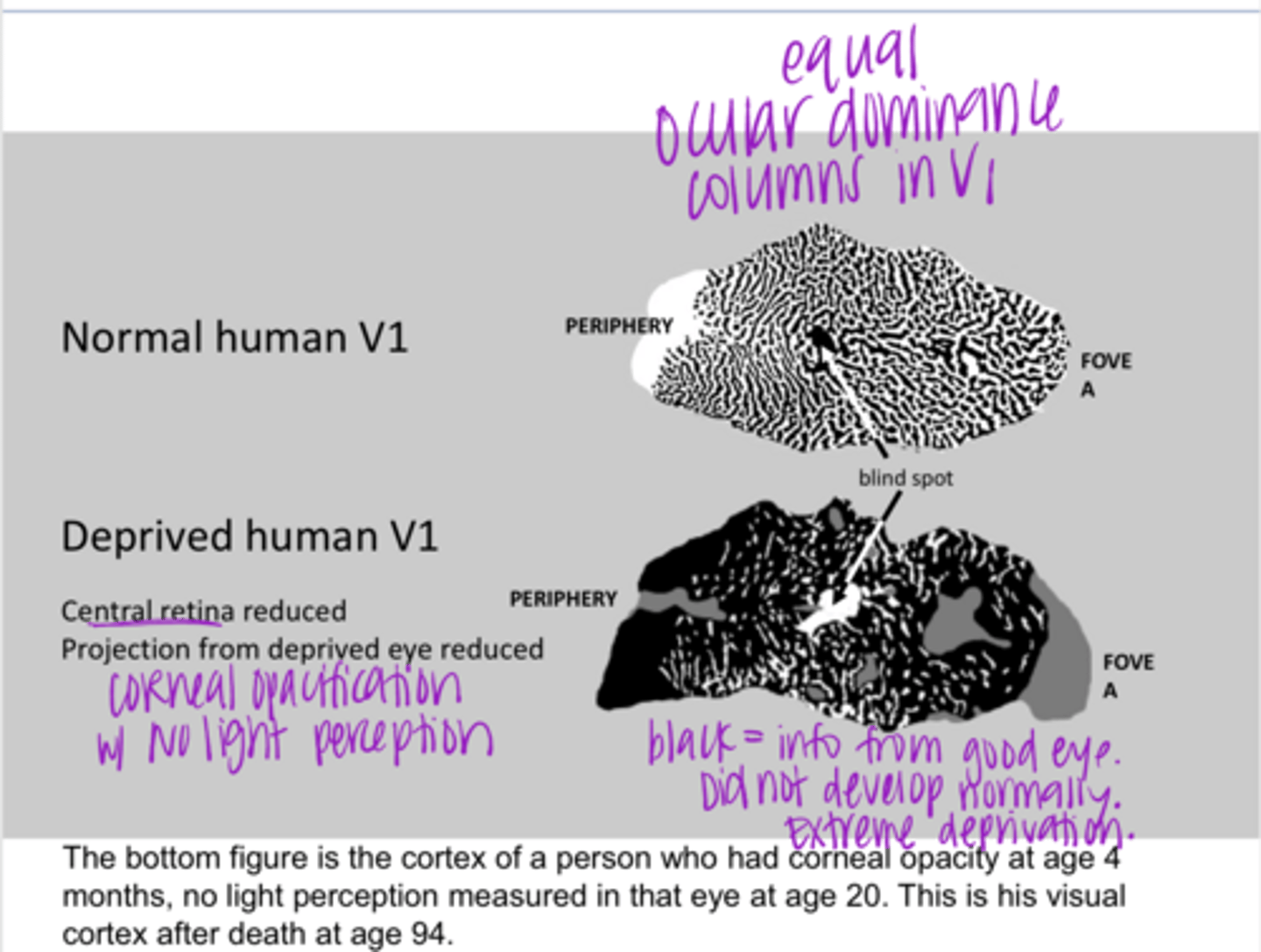 <p>Normal Human V1 v Deprived Human V1 (Pic)</p><p>**in the deprived human, the central retina is reduced &amp; projection from the deprived eye is reduced. Black = good eye info. Extreme deprivation shown</p>