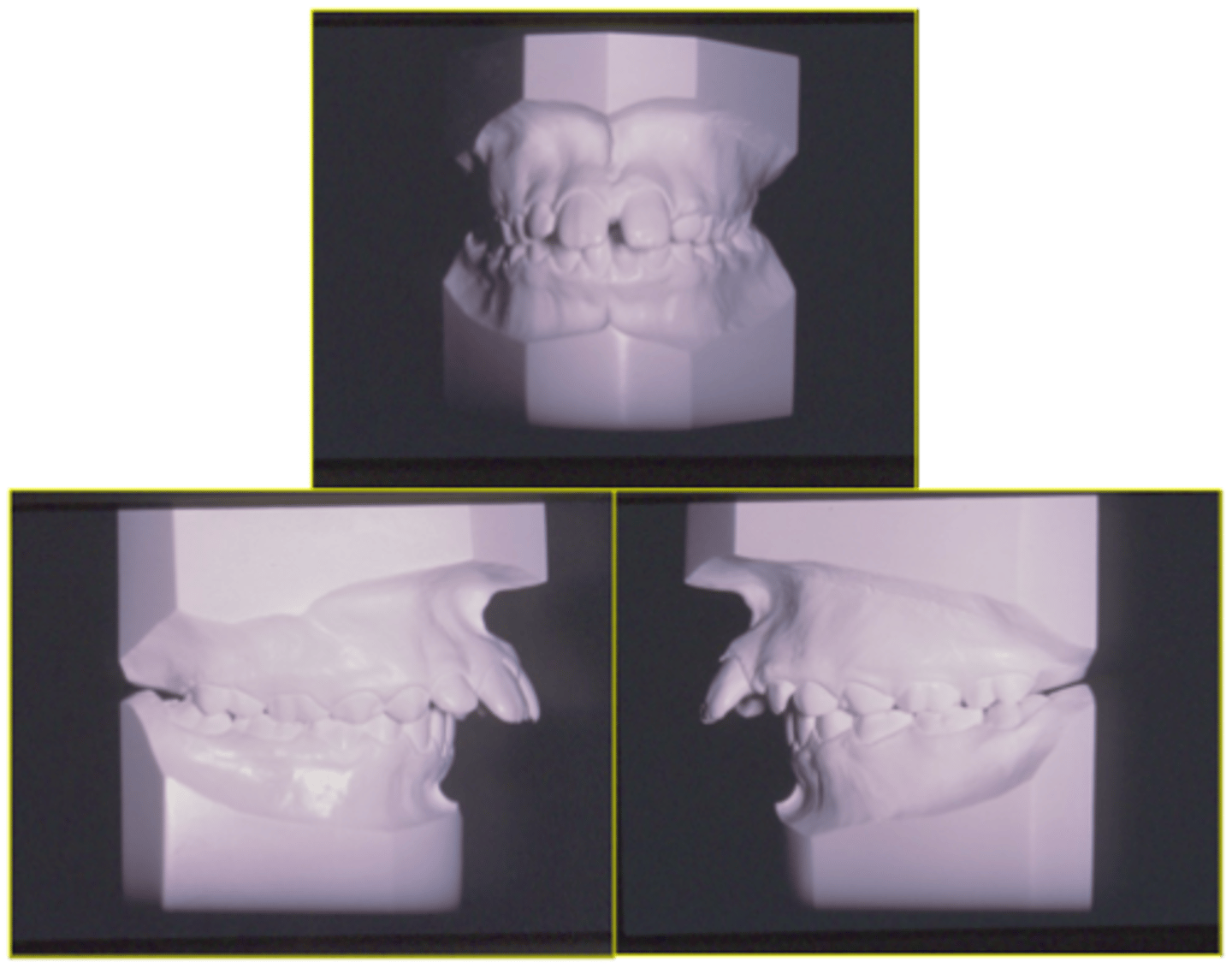 <p>ID the class of occlusion:</p>
