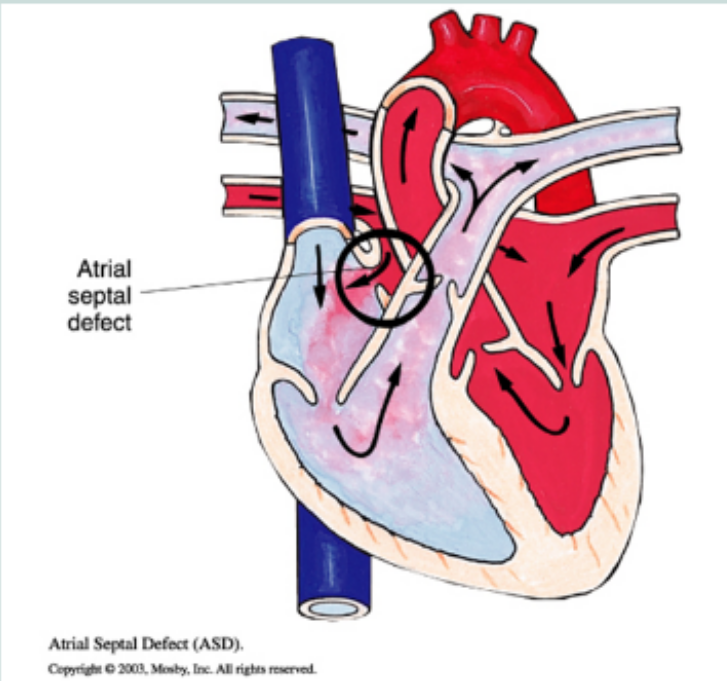 <p>hole between the atria where oxygenated blood from left atrium is shunted to the right atrium and lungs, systolic murmur is heard, surgical closure before school age, acyanotic</p>
