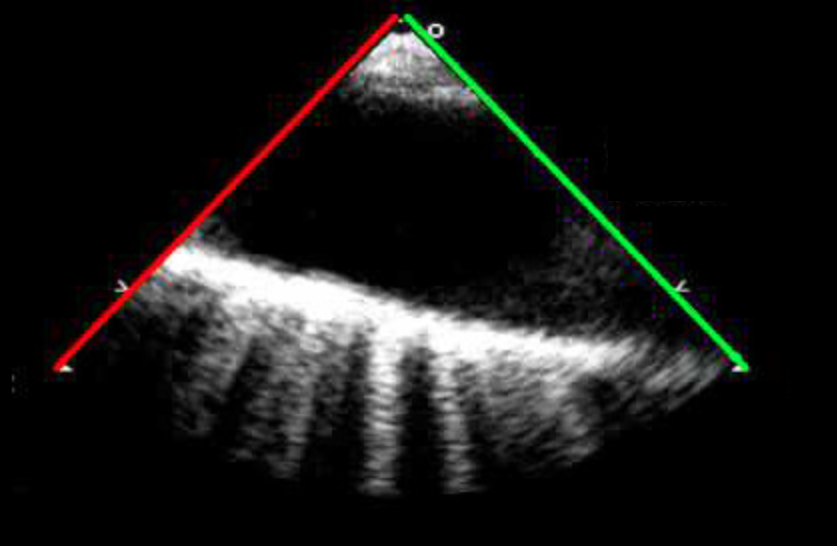 <p>TEE Midesophageal descending thoracic aorta LAX taken at 90-100 degrees</p>