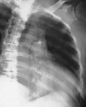 <p>What is this x-ray demonstrating?</p>