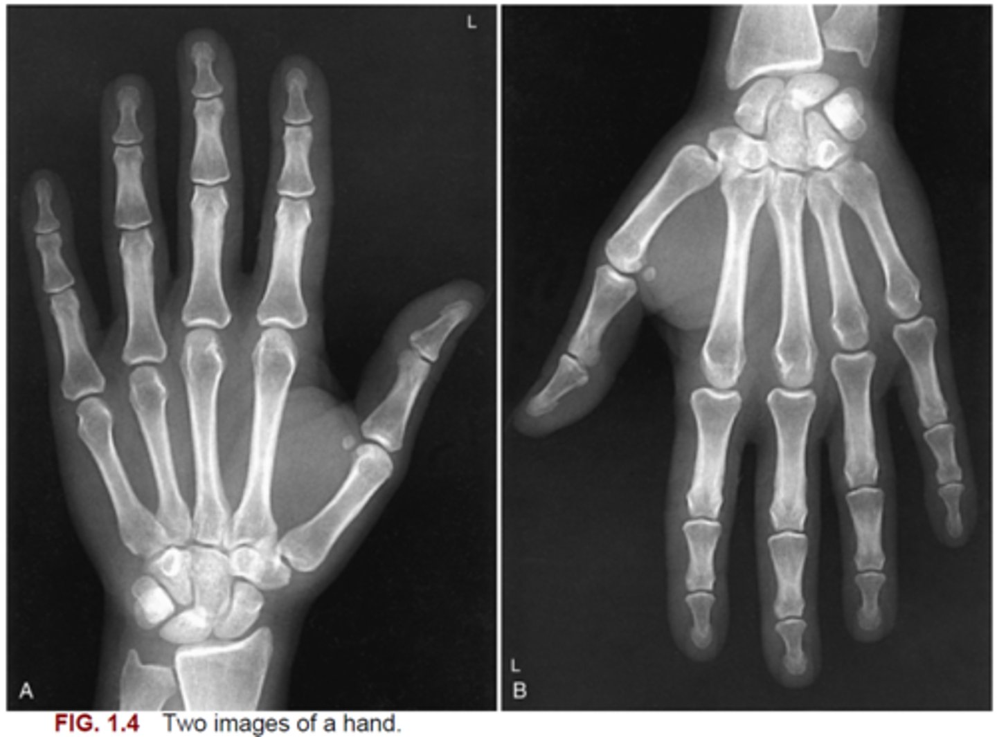 <p>73. Fig. 1.4 shows two images of a PA left hand radiograph. Which image (A or B) is correctly displayed?</p>