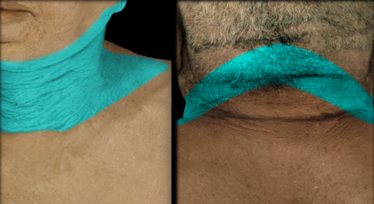 <p>Dermatome: Neck, posterior cheek, temporal area, mandible</p><p>Muscles innervated: Trap, Splenius capitis</p><p>Reflexes (if any): None</p><p>Paresthesias: Cheek, side of neck</p>