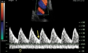 <p>If we are dopplering at the umbilical artery, would this image indicate normalcy or abnormality? </p>
