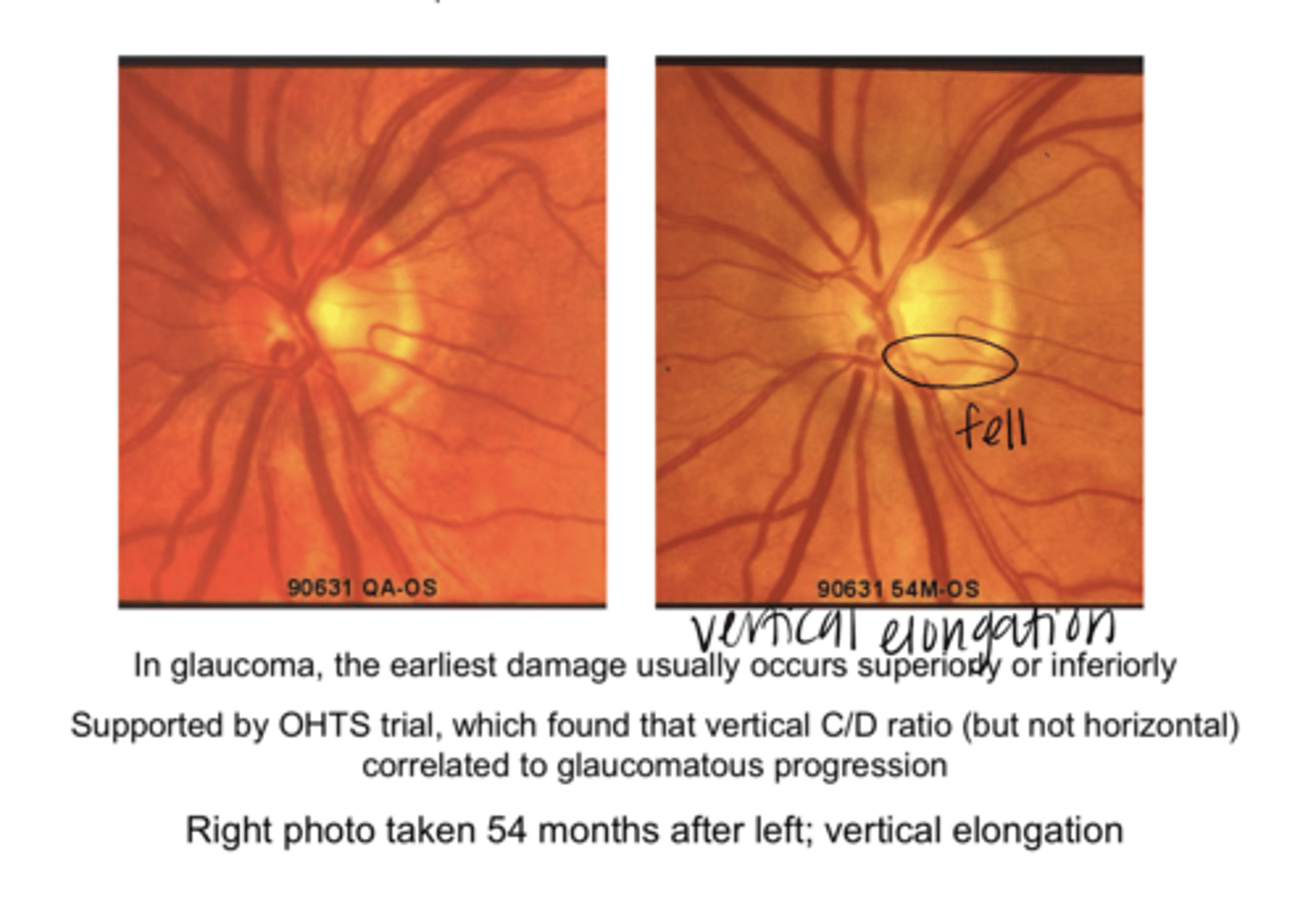 <p>The (vertical/horizontal) C/D ratio correlates to glaucomatous progression</p>