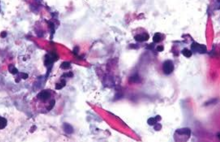 <p>Cristales de Charcot-Leyden</p><p></p>