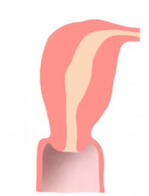 <p>– Incomplete development of one side of the</p><p class="p1">uterus leads to a unicornuate uterus (i.e., a</p><p class="p1">uterus with one tube)</p><p class="p1">– The uterus will appear small and more</p><p class="p1">lateral in position on sonogram</p><p class="p1">– A rudimentary horn may be visible</p><p class="p1">This is?</p>