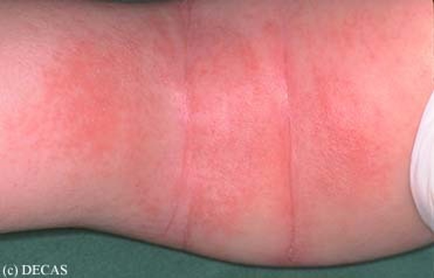 <p>Erythema</p>