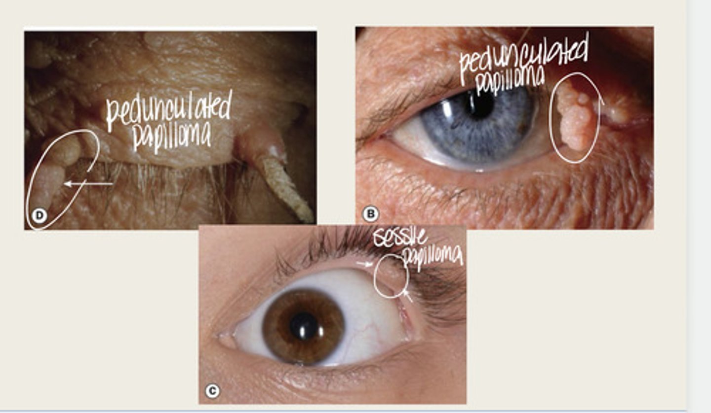 <p>What are the typical appearances of squamous cell papilloma?</p>