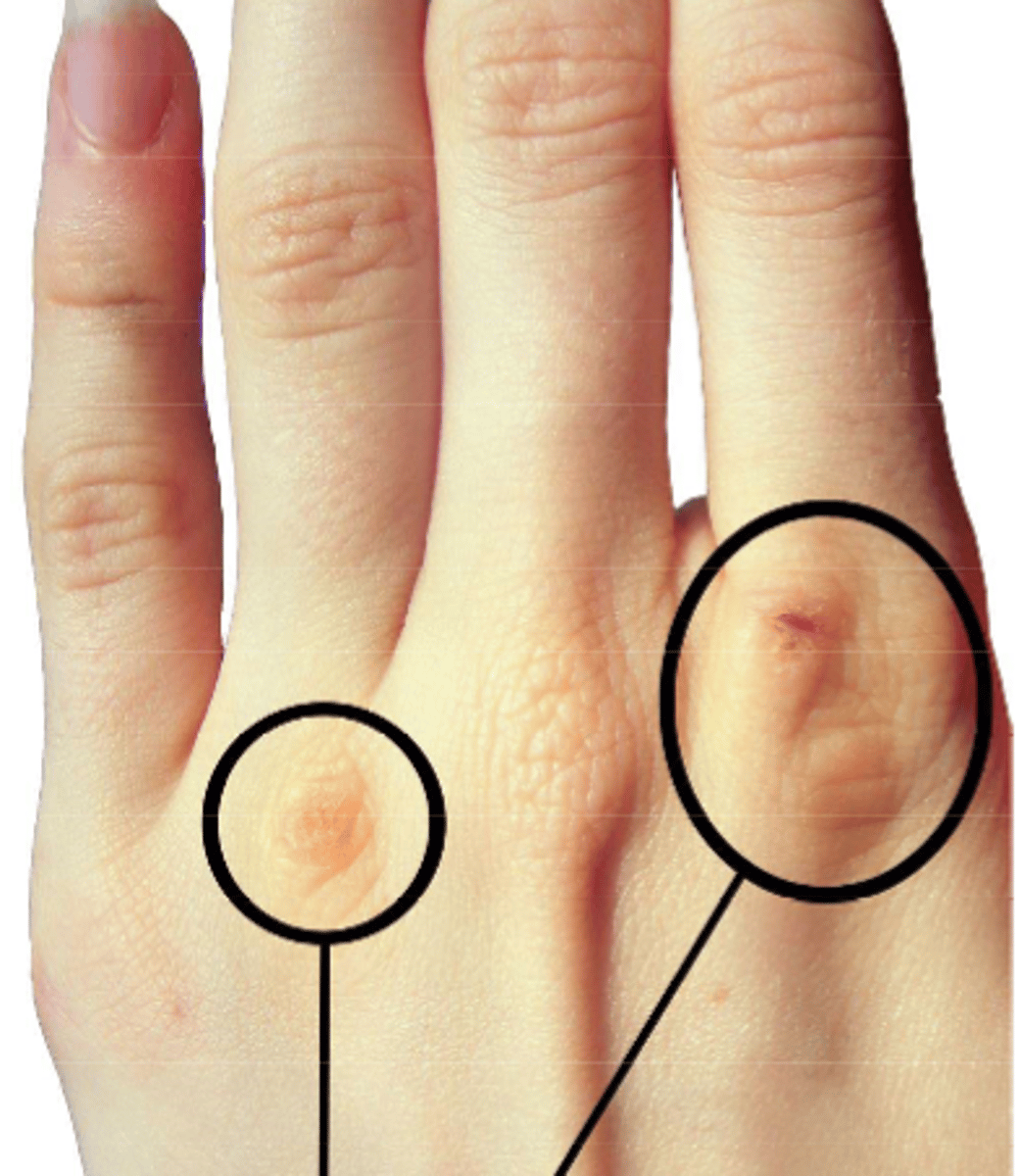 <p>this is associated with people who force themselves to throw up. What is this called?</p>