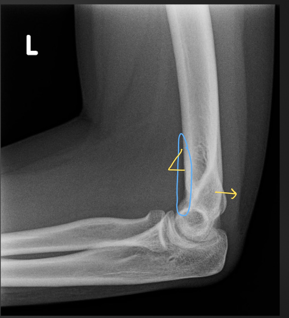 <p>if the anterior fat pad is raised what is that sign called </p>