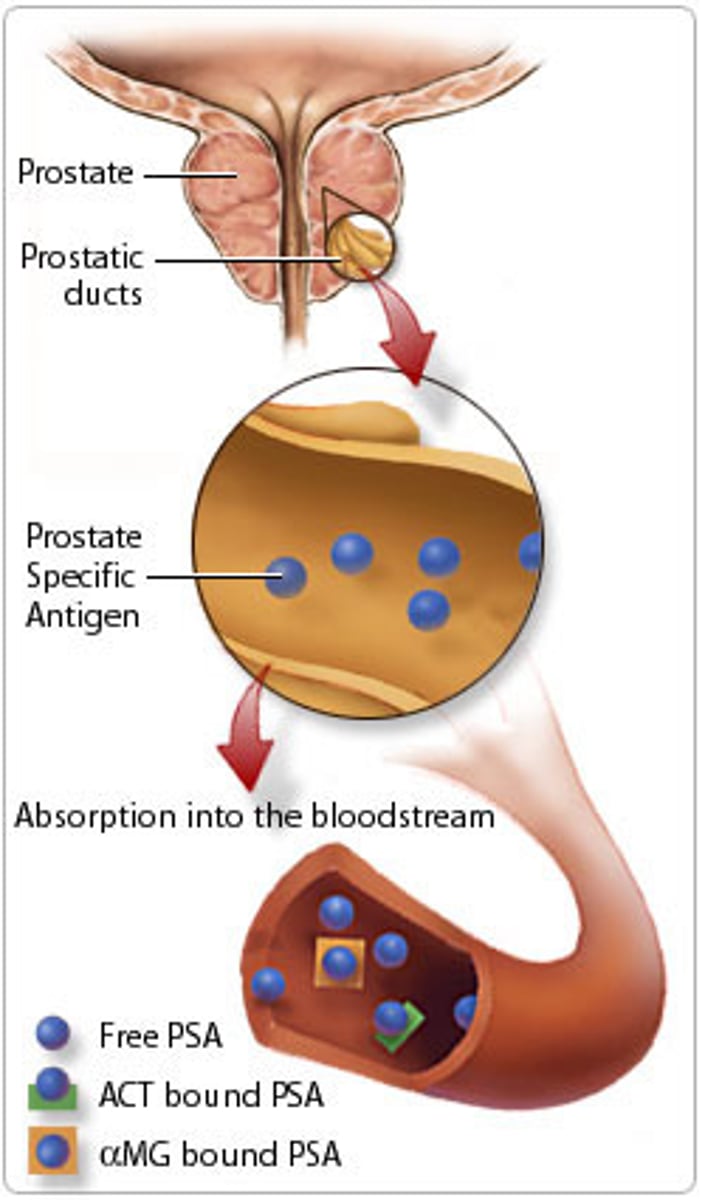 <p>blood test that measures the level of prostate-specific antigen in the blood. Elevated test results may indicate the presence of prostate cancer, urinary or prostatic infection, or excess prostate tissue, as found in benign prostatic hyperplasia or prostaitis</p>