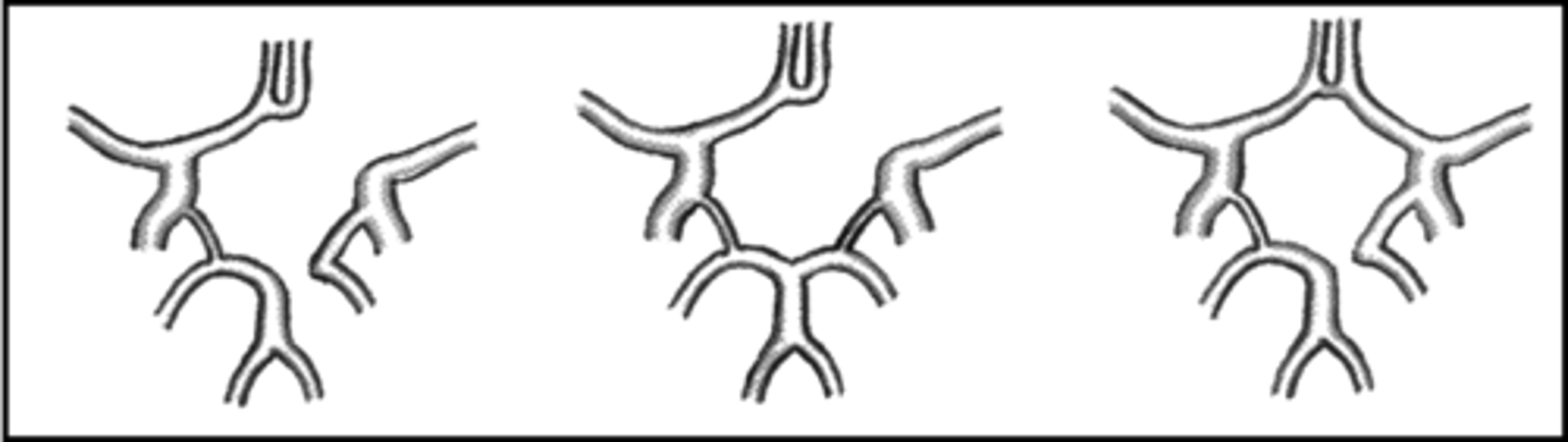 <p>-incomplete Circle of Willis</p><p>-ligation of one carotid artery can induce stroke/cerebral infarction</p>