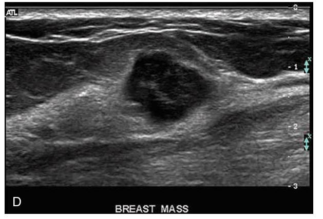<p>A solid lesion that is markedly ________ relative to the normal breast parenchyma is more suspicious for malignancy </p>