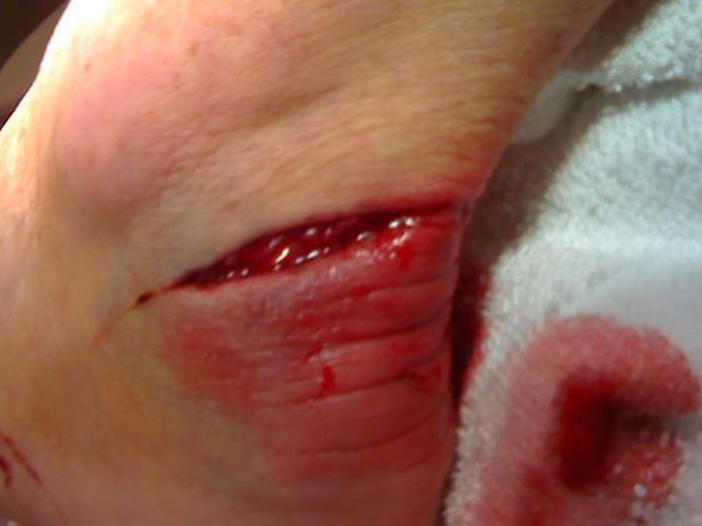 <p>a cut with either jagged or smooth edges, usually from a sharp object. Can also result when a blunt force splits the skin</p>