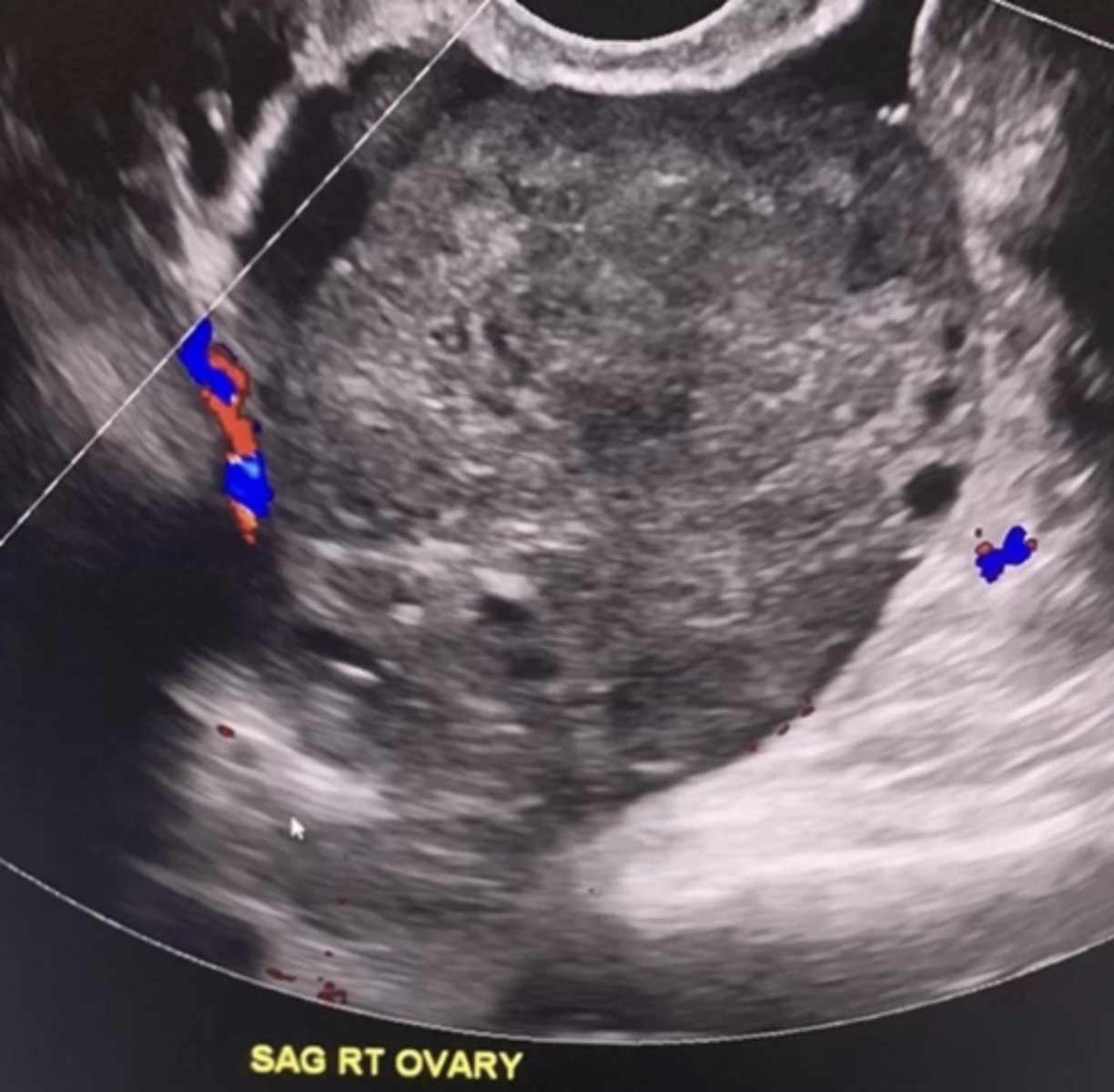 <p>Ovarian torsion</p>