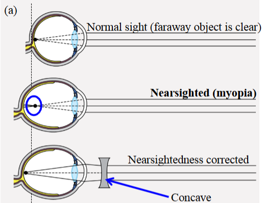<ul><li><p>Eye is too long for the lens’s focusing power.</p></li><li><p>Excessive refraction causes the image to focus in front of the retina.</p></li><li><p>Can see near objects, but not far.</p></li><li><p>Treated with glasses (concave lens) or laser eye surgery.</p></li></ul><p></p>