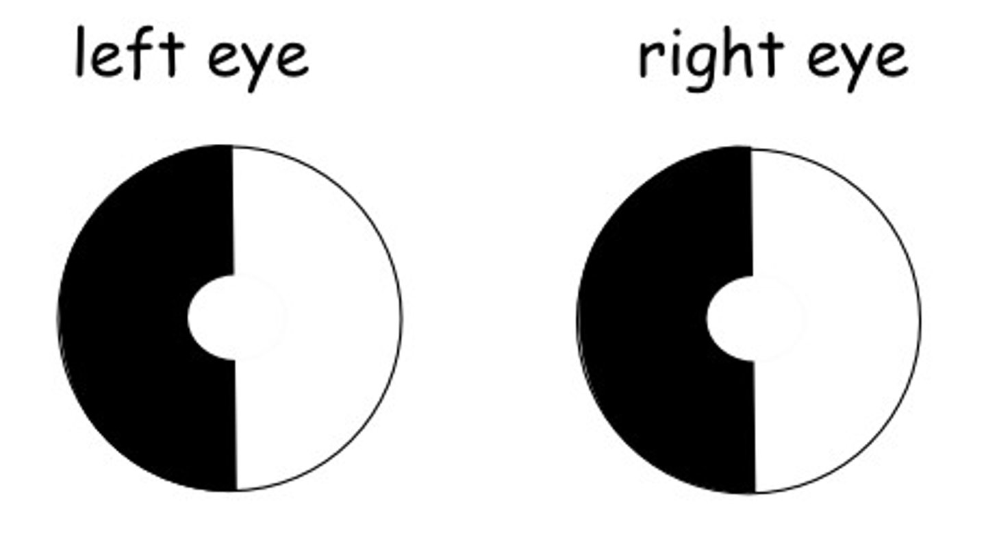 <p>- homonymous --&gt; loss of vision in half of the visual field in both eyes</p><p>- hemianopia --&gt; vision loss </p><p>NURSING: </p><p>- RAPID neurological assessments </p><p>- determine baseline neurological functioning </p><p>- safety assessments </p><p>- time length of TIA </p>