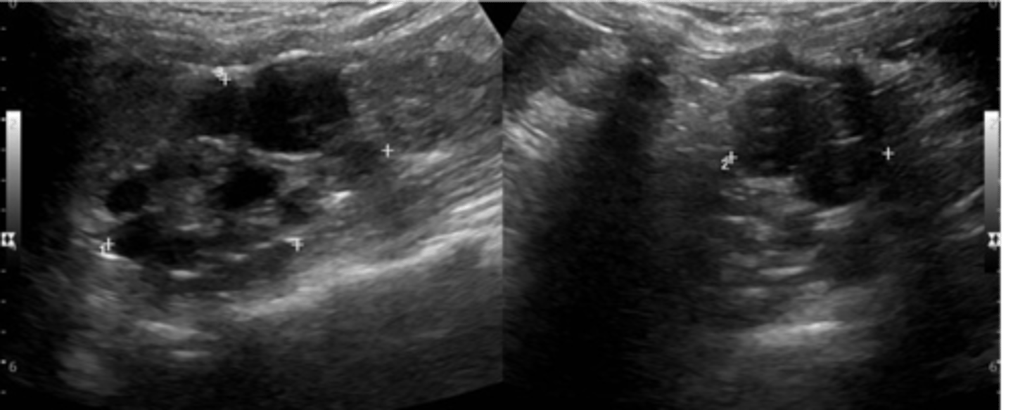 <p>MCDK appears as multiple ___ cysts of varying sizes with no ___ seen</p>