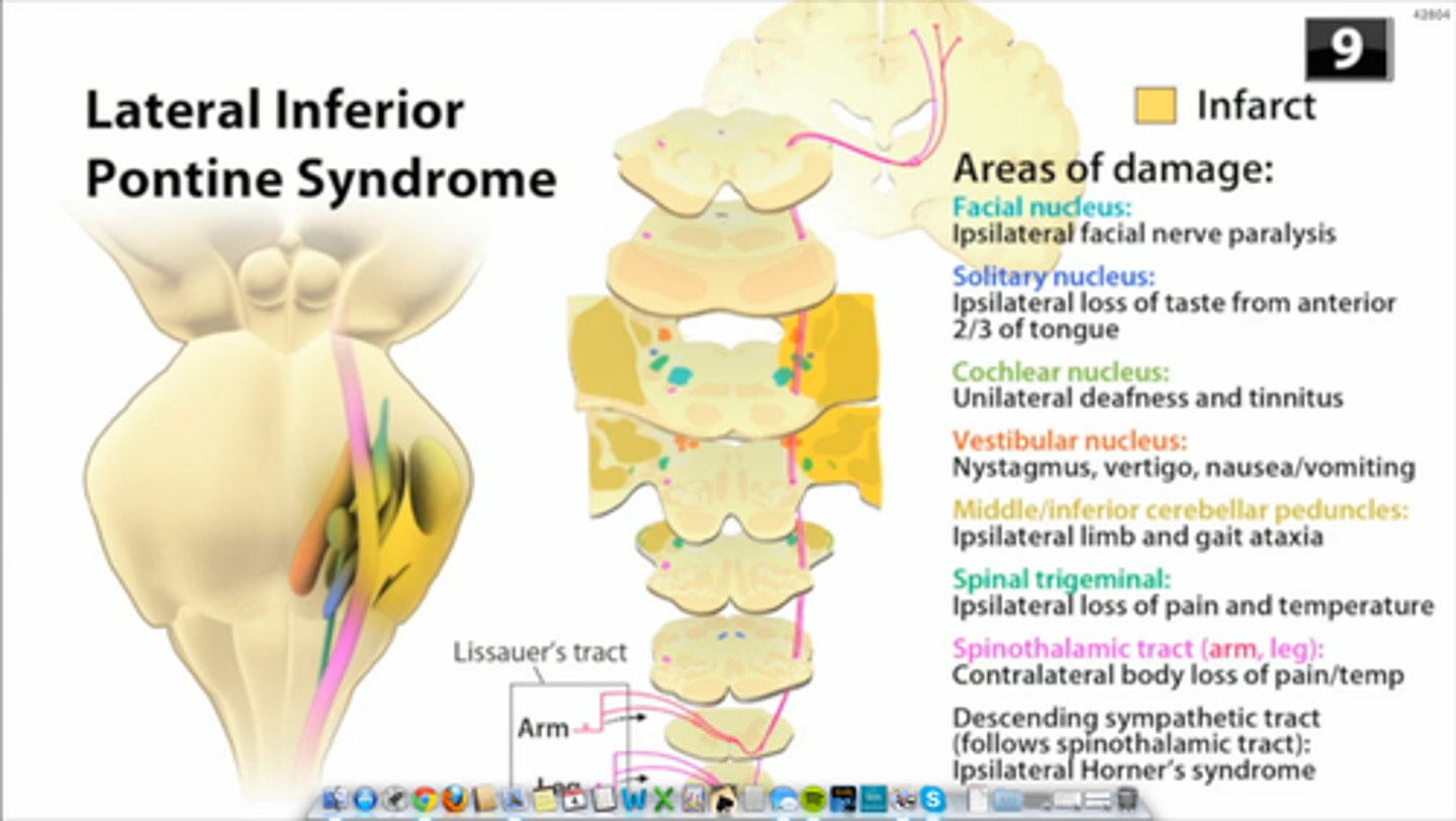 <p>occlusion of the anterior inferior cerebellar artery; Characteristics:</p><p>Ipsilateral to lesion: cerebellar ataxia, nystagmus, vertigo, facial paralysis, paralysis of conjugate gaze to side of lesion, deafness, tinnitus, impaired facial sensation</p><p>Contralateral to lesion: impaired pain and temperature sensation half of body</p>