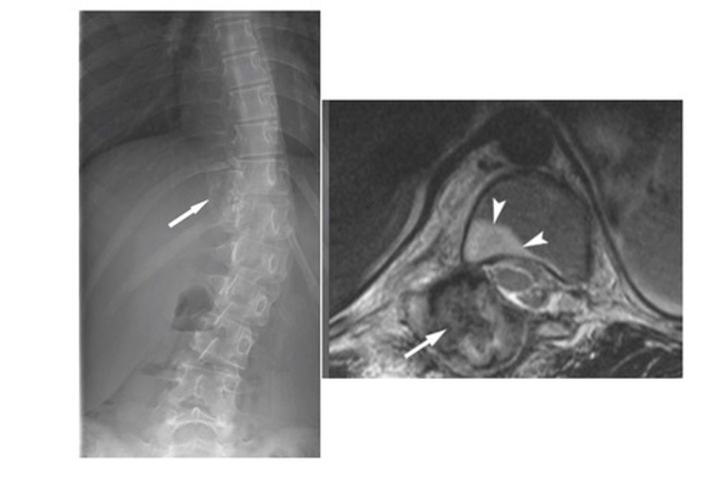 <p>What type of scoliosis is this?</p>