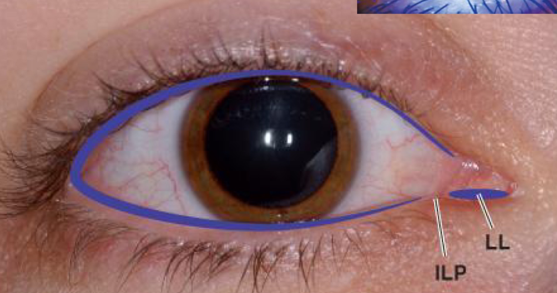 both top and bottom lids