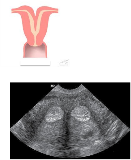 <p>– Improper fusion leads to two partially or completely separate bicornuate uterine cavities.</p><p class="p1">– The uterus is heart-shaped</p><p class="p1">– <strong><em>Most common congenital uterine anomaly.</em></strong></p>
