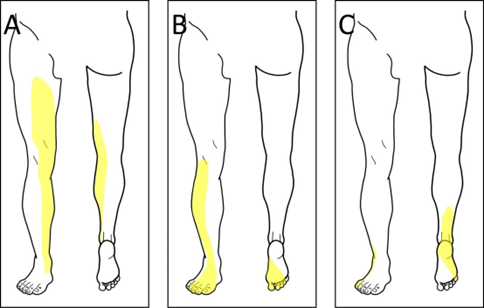 <p>Student Doctors - See if you can guess the lesion/etiology from patterns of sensory loss!</p><p>See the attached figure and the clues below. Answers at the bottom!</p><p>Pt A: 60-year-old female with poorly controlled diabetes and difficulty walking</p><p>Pt B: 50-year-old male who says his right foot slaps the floor when he walks</p><p>Pt C: 58-year-old male with difficulty walking</p>