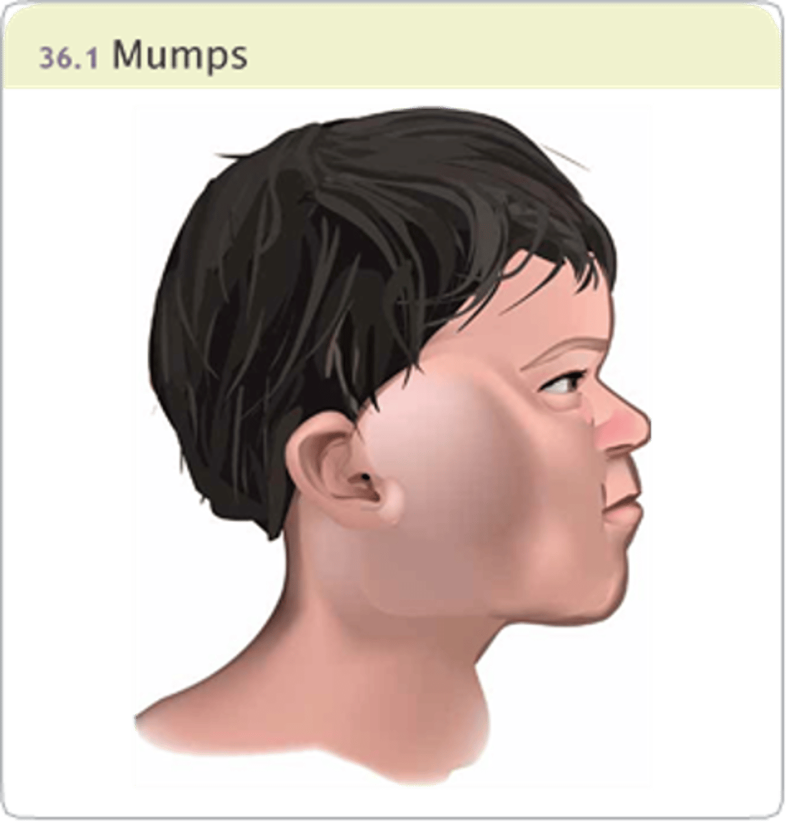 <p>•Spread: Direct Contact</p><p>•Incubation: 14 to 21 days</p><p>•Contagious: Immediately before and after swelling begins</p><p>•Painful, swollen parotid glands</p><p>•Fever and muscle aches</p><p>•Headache</p><p>•Earache made worse by chewing</p><p>•Fatigue and loss of appetite</p>