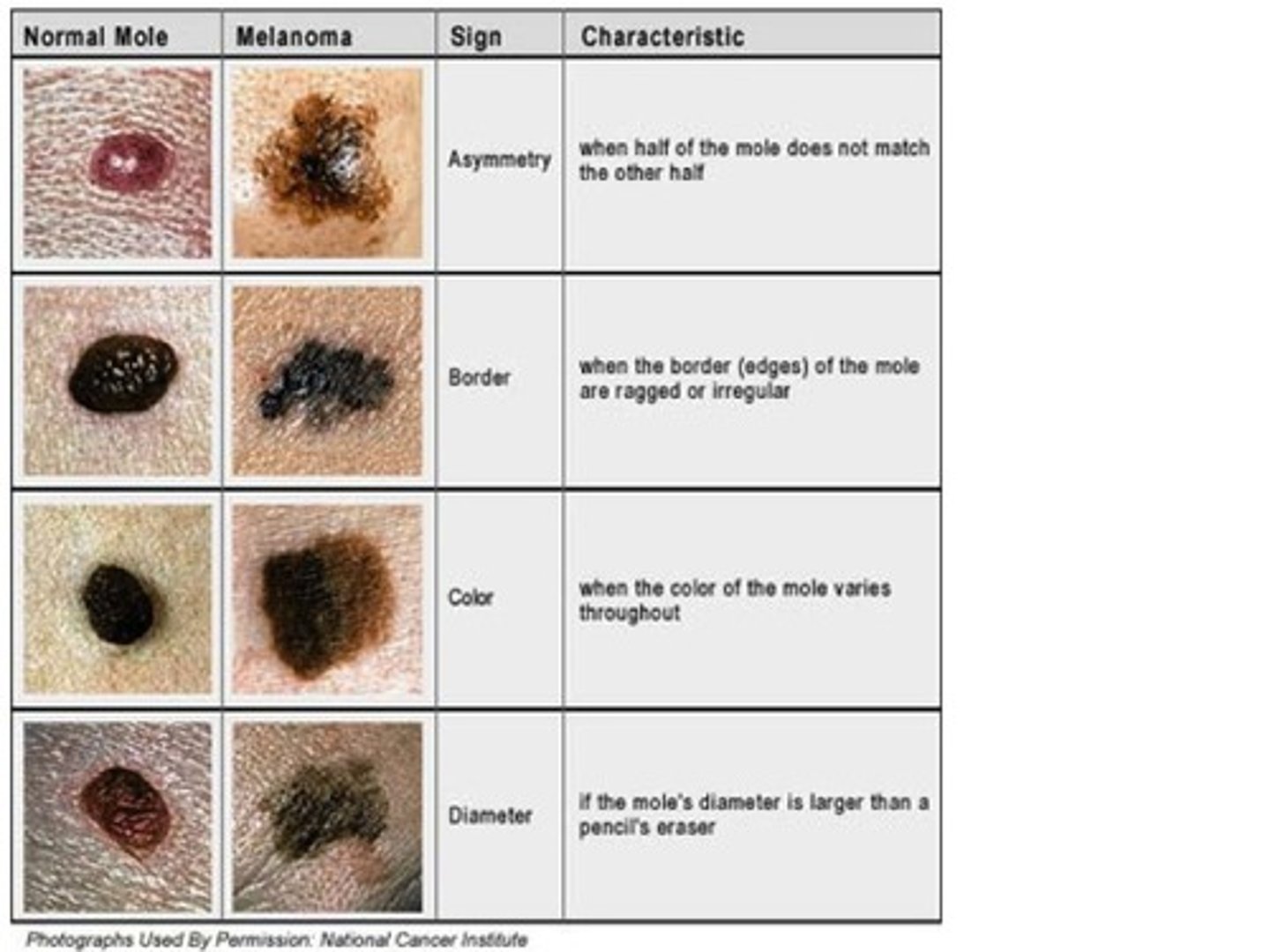 <p>Most serious form of skin cancer; often characterized by black or dark brown patches on the skin that may appear uneven in texture, jagged, or raised.</p>