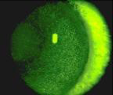 <ul><li><p>ocular surface inflammation in dry eye<mark data-color="purple" style="background-color: purple; color: inherit;"> exacerbated</mark> by preservatives&nbsp;</p></li></ul><p>—> removing key element in managing dry eye</p><p></p><ul><li><p>Benzalkonium chloride (BAK) cause <strong>epithelial toxic effects</strong> based on dose + tear film&nbsp;</p></li></ul><p></p><ul><li><p>BAK toxic to corneal epithelium , causing <strong><mark data-color="green" style="background-color: green; color: inherit;">erosion</mark></strong> → <strong><mark data-color="green" style="background-color: green; color: inherit;">punctate staining</mark></strong></p></li></ul><p></p><ul><li><p>detergent properties , preservs <mark data-color="green" style="background-color: green; color: inherit;">destabilise tear film</mark> by dissolving lipid layer&nbsp;</p></li></ul><p></p><ul><li><p>increase of <u><mark data-color="green" style="background-color: green; color: inherit;">evaporation</mark></u> leads to ocular dryness&nbsp;</p></li></ul><p></p>