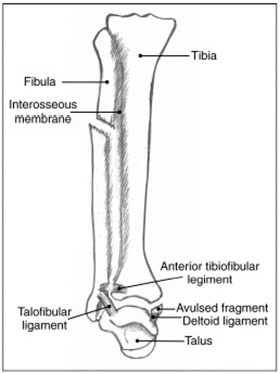 <p>∙Fibular neck fracture.</p><p>∙Proximal fibular fracture due to external rotation.</p><p>∙Energy of rotation transfers through the interosseous ligament and exits at proximal fibula.</p><p>∙Requires Syndesmotic fixation.</p>