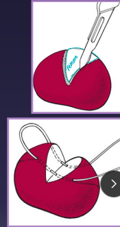 <ul><li><p><span style="color: red;"><strong>#1</strong></span><strong> FNA!!: </strong>bacti, fungal, neoplasia, culture, staging, tx planning</p><ul><li><p>screening tool, <u>cellular only</u>, <u>specific</u> but not sensitive</p></li></ul></li></ul><ul><li><p><strong>Needle (Tru-Cut) biopsy: </strong>Lg accessible LN</p><ul><li><p><u>Lg bore (14-16g)</u>, aseptic, <u>core sample</u> (small)</p><ul><li><p>Only be done in areas that allow it - no important organs/BV near </p></li></ul></li></ul></li><li><p><strong>Incisional (wedge/removal) Biopsy:</strong> small LN, tricky location</p><ul><li><p>Stabilize node, wedge excision, close capsule(H. mattress)</p></li></ul></li><li><p><strong>Lymphadenectomy Excisional (LN removal): </strong>smaller node, evaluate for metastasis - does not prevent mets</p><ul><li><p>Full dissection, ligate vessels</p></li></ul></li><li><p><strong>Sample Preservation: </strong>Neoplasia (formalin fixed), Bacti (fresh), Fungal (fresh/frozen), impression smears - cytology</p></li></ul><p></p>