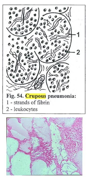 <p><strong>crupous (fibrinous lobar) pneumonia and chronic interstitial pneumonia</strong></p><p>notes: </p><ul><li><p><em>1st layer: chronic intestinal pneumonia (nederst)</em></p></li><li><p><em>2nd layer: respond to secondary infection (exudate)</em></p></li><li><p><em>3rd layer: severe accumulation neutrophils</em></p></li><li><p><em>4th layer: fibrous (upper with all the white spaces)</em></p></li></ul><p><em>Bacterial origin, or fungi chyle formation, fibrin (blood protein) escapes from bv to extravascular space - formation of mass</em></p><p><em>cant see alveoli. </em></p><p><em>Nederst på bildet: fibroblasts and fibrocytes replace lung tissue. Exudation above this tissue. Line of neutrophils above exudation. Øverst: lung tissue (alveoli) with infiltration of neutrophils and exudation. </em></p>