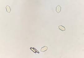 <p>rare but insignificant, acid urine</p>