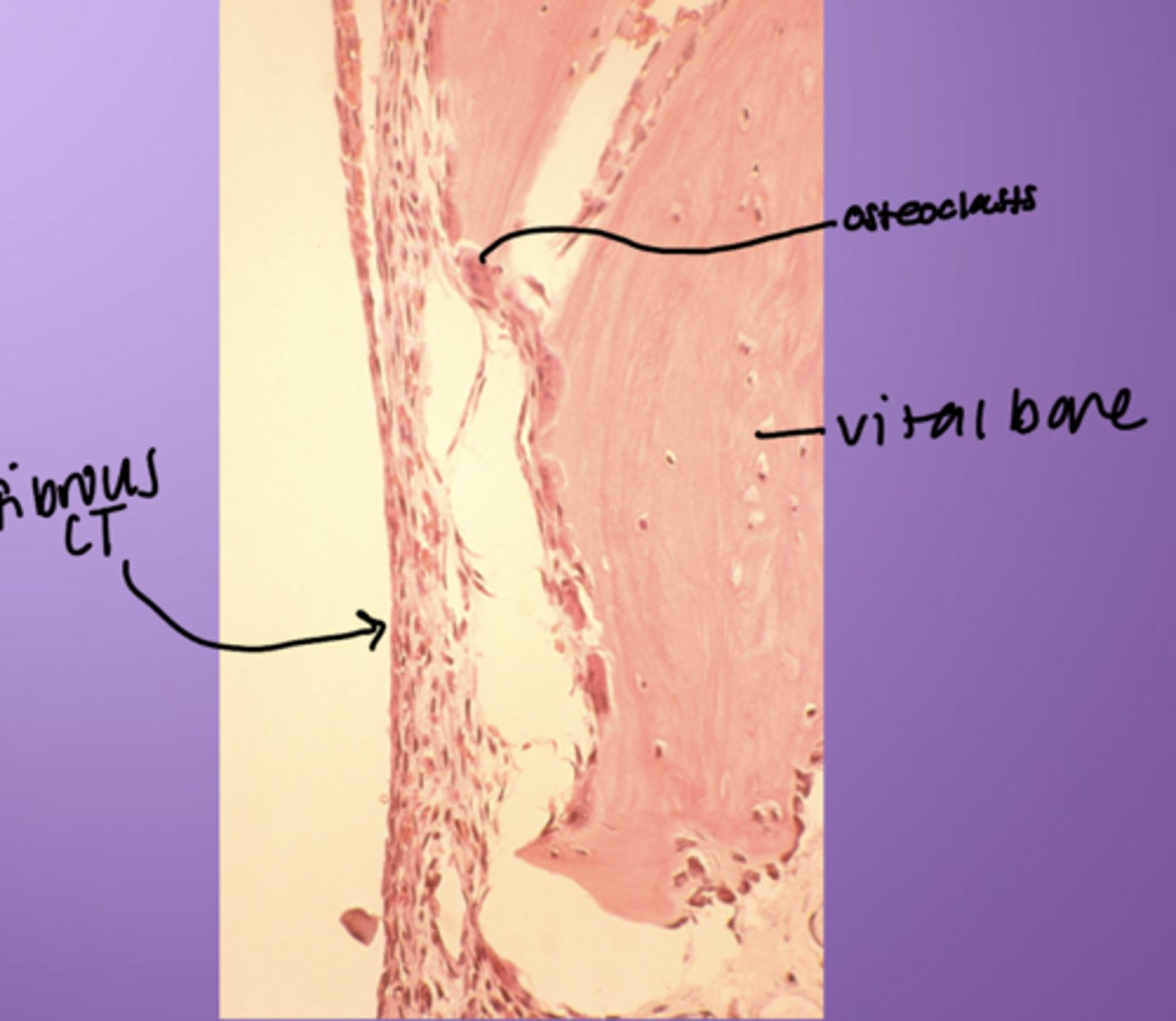 <p>- Osteoclasts</p><p>- Vital bone</p><p>- Fibrous CT</p>