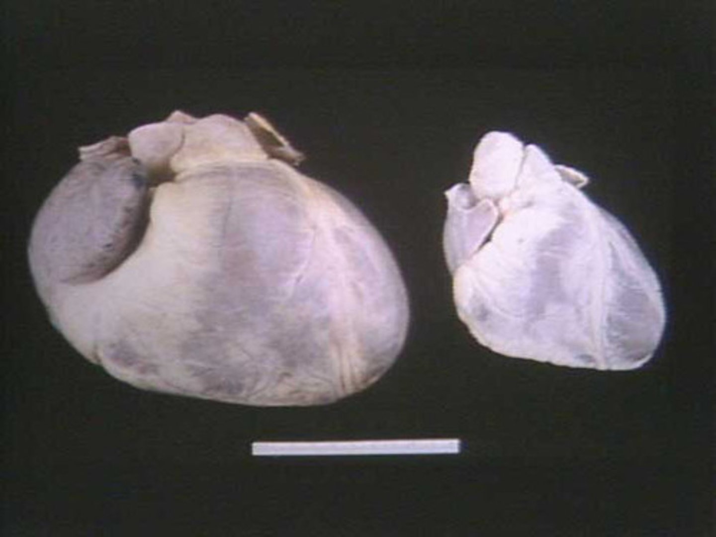 <p>enlargement of the heart</p>