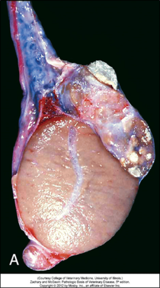 <p>- Spermatic granuloma is an inflammatory condition not caused by infection, but as response to extravasated spermatozoa (like from vasectomy/trauma/obstruction)</p><p>- The inflammation predominantly involves the efferent ducts (which are part of the spermatic duct system) and can spread to the head of the epididymis as well.</p><p>-get incrs in size of head of epididymis</p>