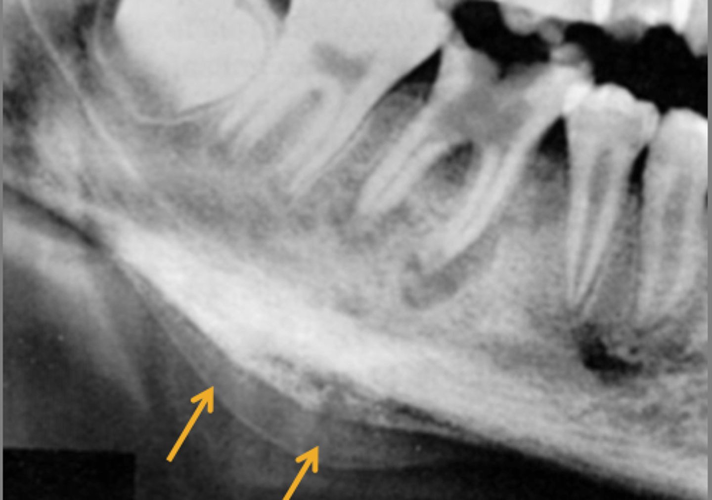 <p>thin convex shell of bone</p><p>laminated/onion skin appearance</p>
